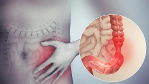 آیا IBS به سرطان روده تبدیل می‌شود؟ راهنمای دقیق افتراق